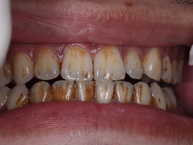 20240513-teeth-whitening-before