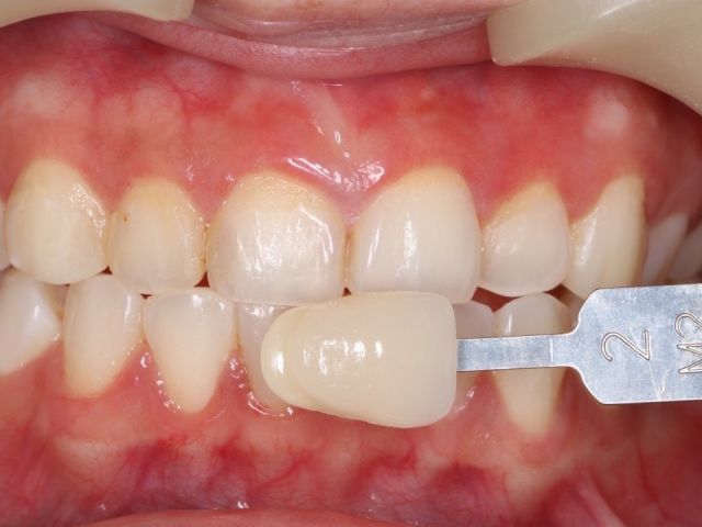 20240621-case-01-teeth-whitening-bleaching-trays-2-lin