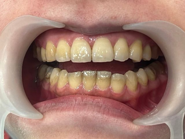 20240723-teeth-whitening-before