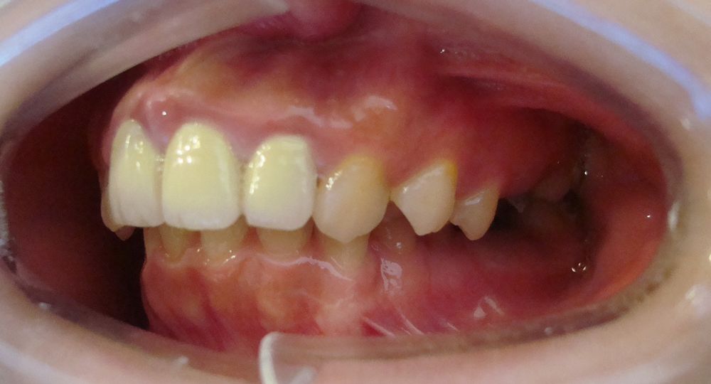 case-crooked-teeth-tu-before-r-2