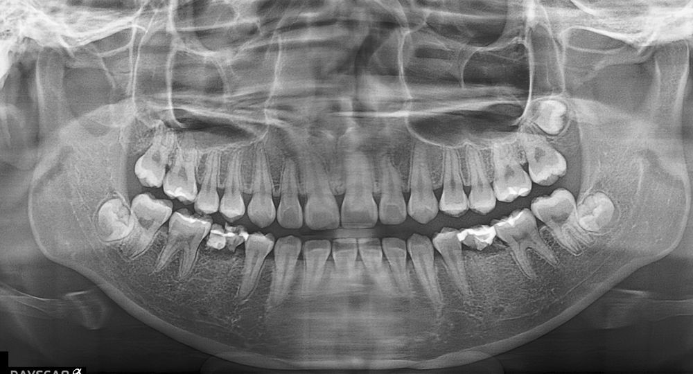 case-hypodontia-hsu-before-x-1