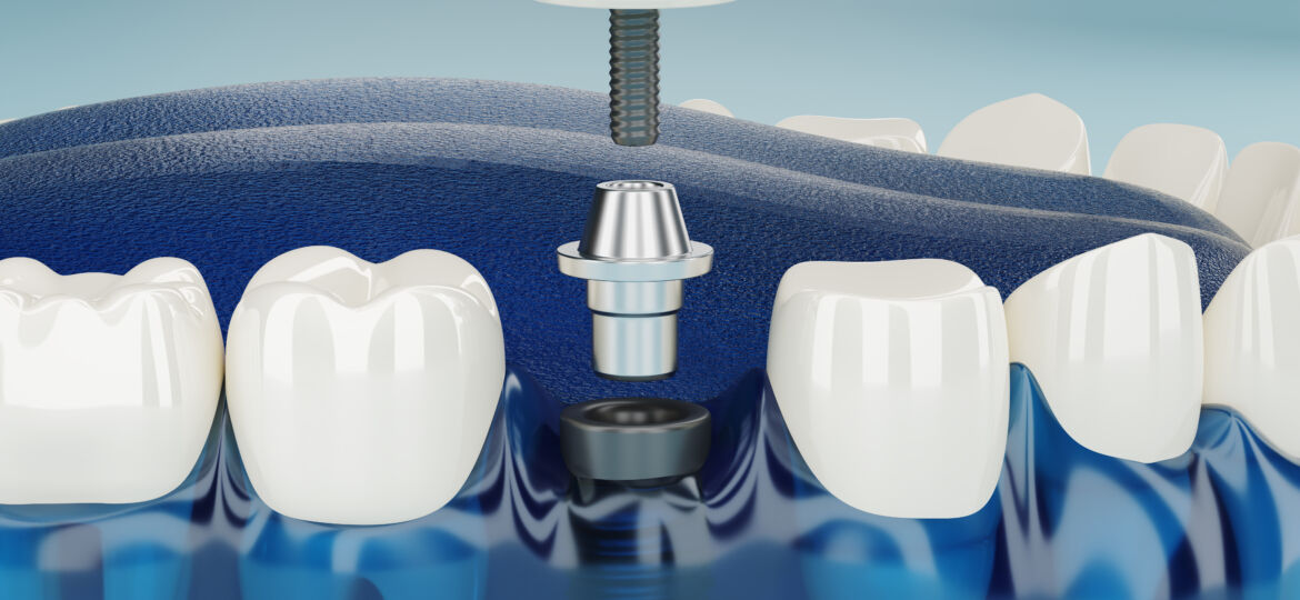 Close up Component of Dental implants transparent. 3D rendering.